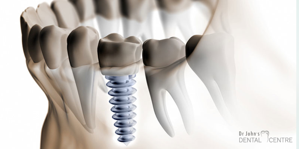 Dental Implants at Dr John's Dental Centre Trivandrum