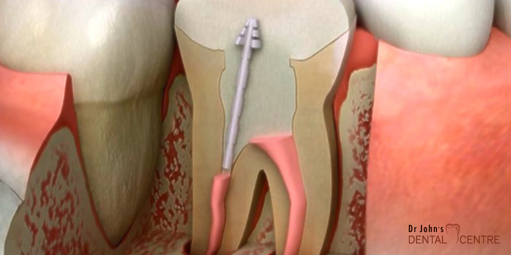 Root Canal Therapy at Dr John's Dental Centre Trivandrum