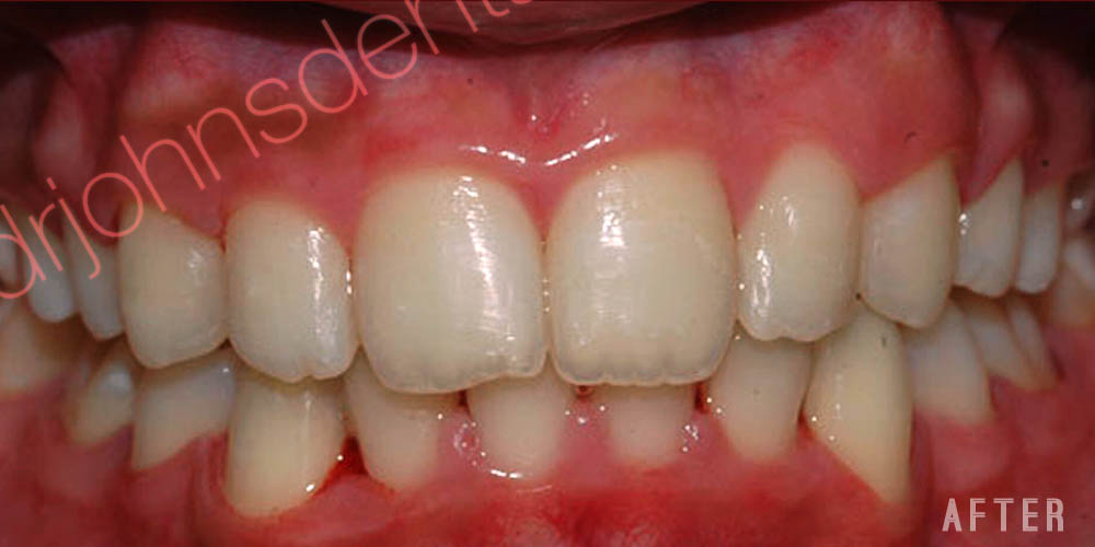 Dr-Johns-Dentistry-Services-Smile-correction