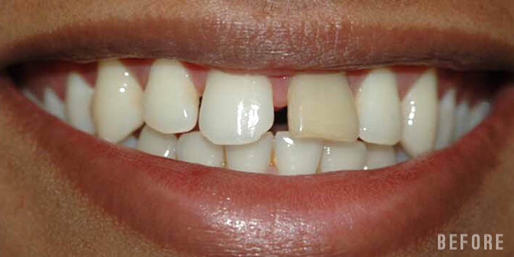 Dr-Johns-Dentistry-Services-Smile-correction